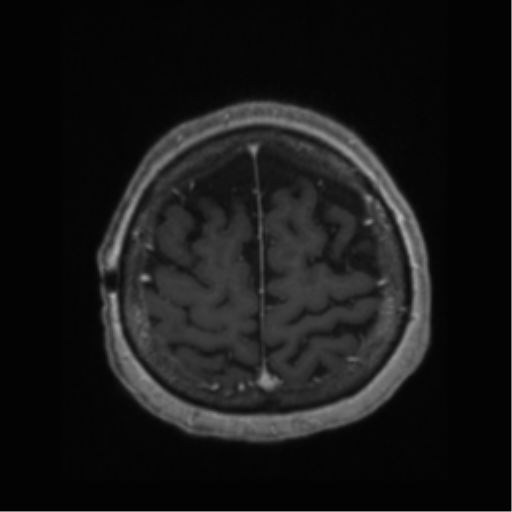 File:Anaplastic astrocytoma IDH wild-type (pseudoprogression) (Radiopaedia 42209-45277 Axial T1 C+ 108).png