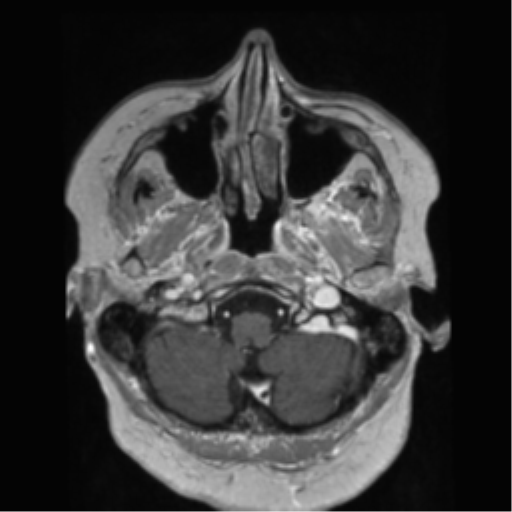 File:Anaplastic astrocytoma IDH wild-type (pseudoprogression) (Radiopaedia 42209-45278 Axial T1 C+ 31).png