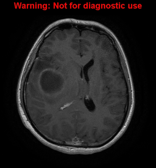 File:Anaplastic ganglioglioma (Radiopaedia 44921-48831 Axial T1 C+ 19).jpg