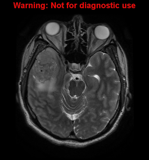 File:Anaplastic ganglioglioma (Radiopaedia 44921-48831 Axial T2 11).jpg