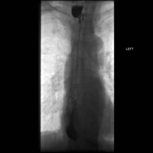 File:Anastomotic stricture post Ivor Lewis esophagectomy (Radiopaedia 47937-52715 B 36).png