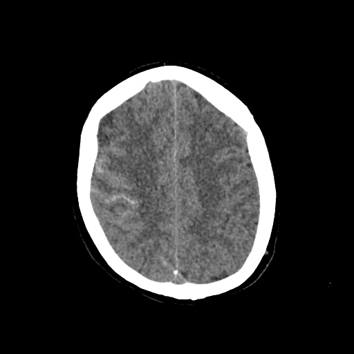 File:Aneursym related subarachnoid hemorrhage with hydrocephalus (Radiopaedia 45105-49083 Axial non-contrast 37).jpg