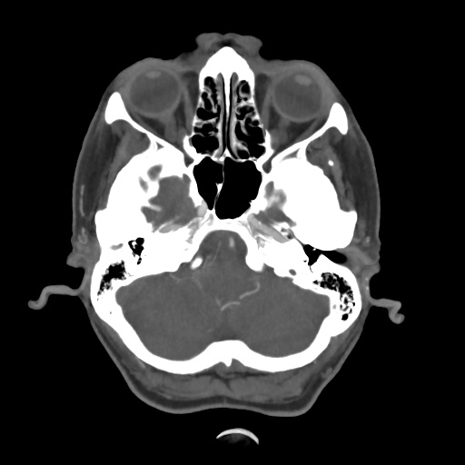 File:Aneursym related subarachnoid hemorrhage with hydrocephalus (Radiopaedia 45105-49084 A 11).jpg