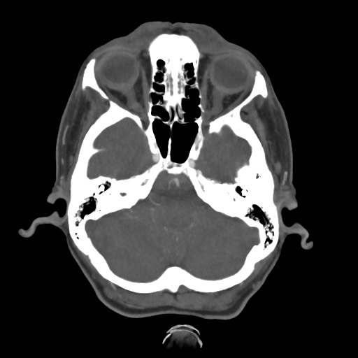 Aneursym related subarachnoid hemorrhage with hydrocephalus (Radiopaedia 45105-49084 A 13).jpg