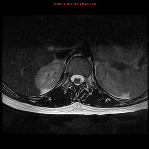 File:Aneurysmal bone cyst (Radiopaedia 9419-10103 Axial T2 20).jpg