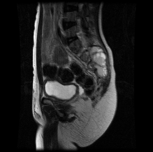 File:Aneurysmal bone cyst - sacrum (Radiopaedia 65190-74196 Sagittal T2 20).jpg