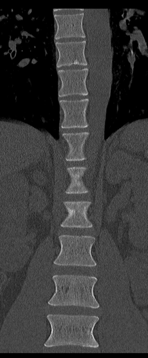 Aneurysmal bone cyst T11 (Radiopaedia 29294-29721 Coronal bone window 18).jpg