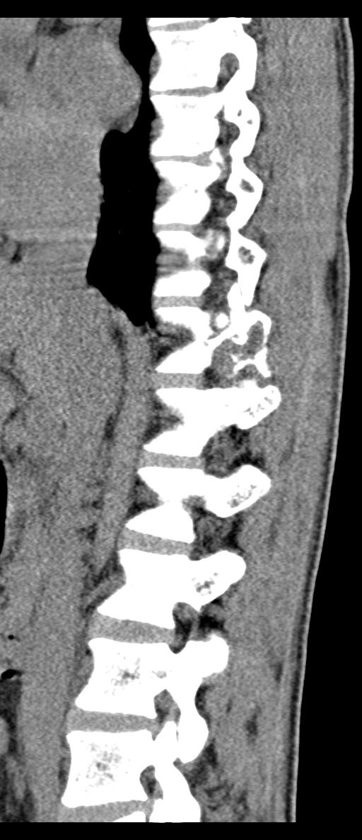 Aneurysmal bone cyst T11 (Radiopaedia 29294-29721 E 51).jpg
