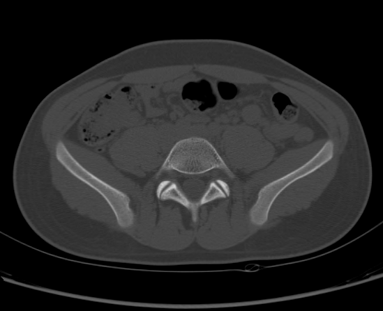 File:Aneurysmal bone cyst of ischium (Radiopaedia 25957-26094 Axial bone window 13).png