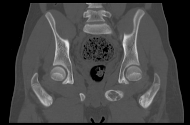 File:Aneurysmal bone cyst of ischium (Radiopaedia 25957-26094 Coronal bone window 24).png