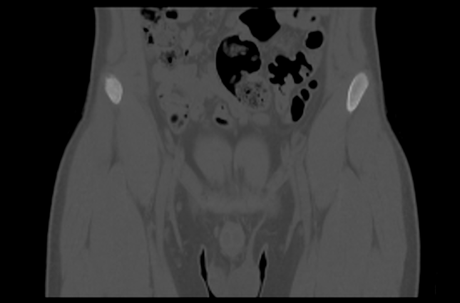 File:Aneurysmal bone cyst of ischium (Radiopaedia 25957-26094 Coronal bone window 5).png