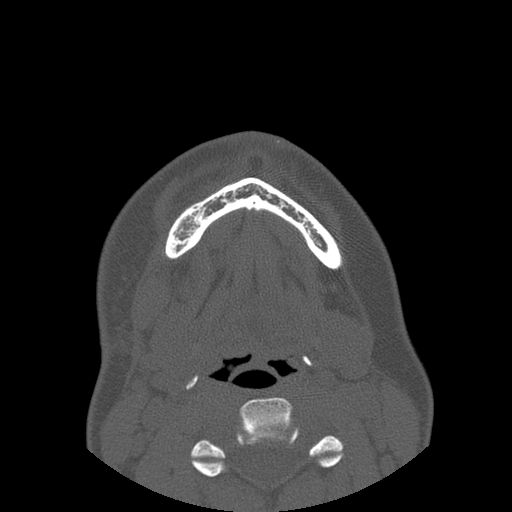 Aneurysmal bone cyst of the mandible (Radiopaedia 43280-46823 Axial bone window 24).jpg