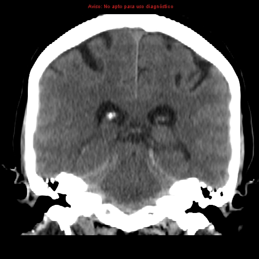 File:Aneurysmal subarachnoid hemorrhage (Radiopaedia 24740-24997 Coronal non-contrast 29).jpg