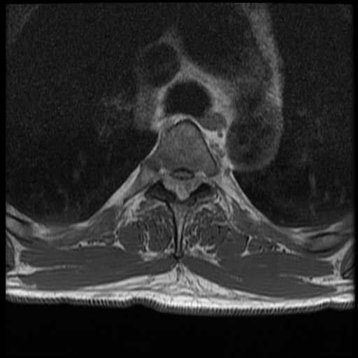 File:Angiolipoma - thoracic spine (Radiopaedia 28242-28479 Axial T1 21).jpg