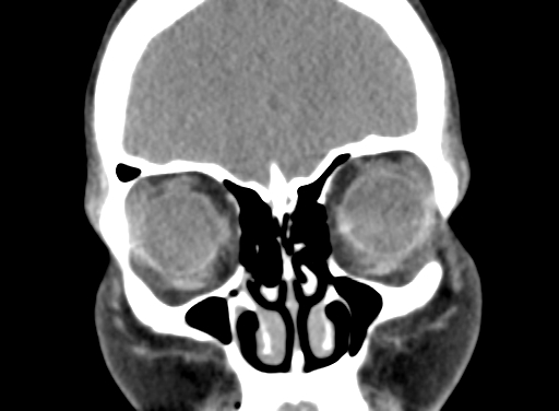 Angular dermoid cyst (Radiopaedia 88967-105790 Coronal non-contrast 21).jpg