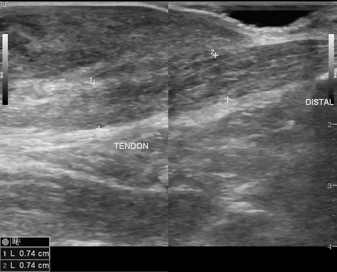 File:Ankle sinus (Radiopaedia 12913-13017 F 1).jpg