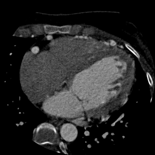File:Anomalous left coronary artery from the pulmonary artery (ALCAPA) (Radiopaedia 40884-43586 A 50).jpg