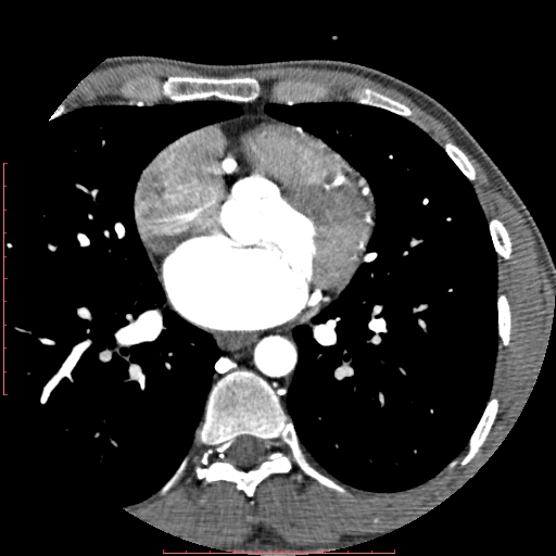 Anomalous left coronary artery from the pulmonary artery (ALCAPA) (Radiopaedia 70148-80181 A 156).jpg