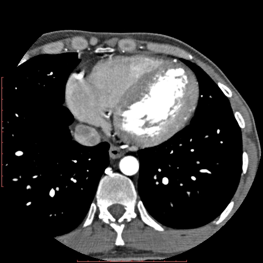 Anomalous left coronary artery from the pulmonary artery (ALCAPA) (Radiopaedia 70148-80181 A 280).jpg