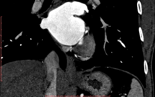 Anomalous left coronary artery from the pulmonary artery (ALCAPA) (Radiopaedia 70148-80181 B 212).jpg