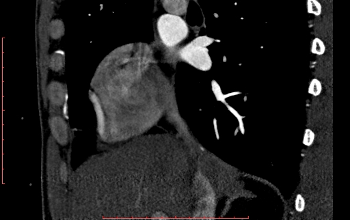 Anomalous left coronary artery from the pulmonary artery (ALCAPA) (Radiopaedia 70148-80181 C 27).jpg