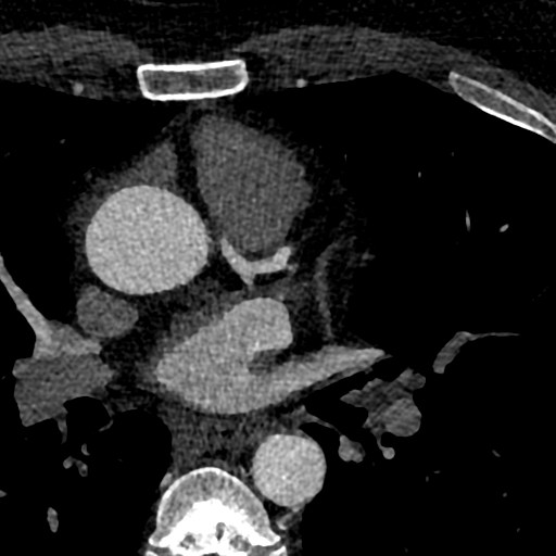 File:Anomalous origin of the left coronary artery with malignant course (Radiopaedia 77842-90126 C 18).jpeg