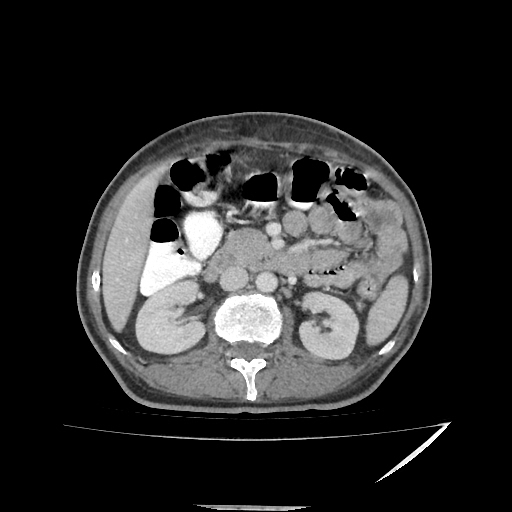 Anorectal carcinoma (Radiopaedia 44413-48064 A 21).jpg