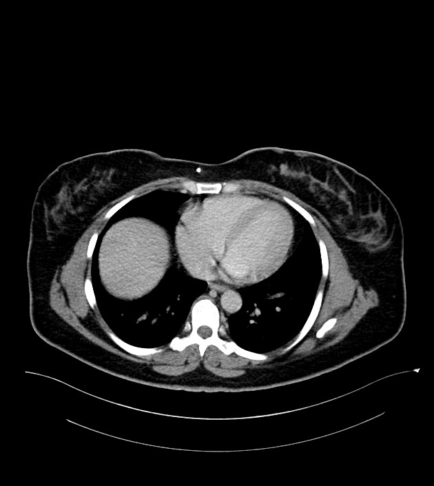 Anterior abdominal wall CSF pseudocyst (CSFoma) (Radiopaedia 79453-92571 A 9).jpg