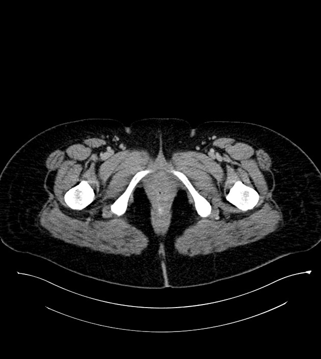Anterior abdominal wall CSF pseudocyst (CSFoma) (Radiopaedia 79453-92571 A 97).jpg