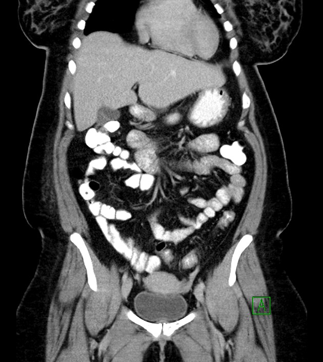 Anterior abdominal wall CSF pseudocyst (CSFoma) (Radiopaedia 79453-92571 B 22).jpg