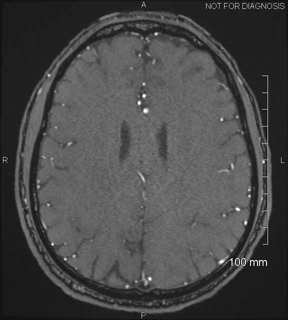 Anterior cerebral artery aneurysm (Radiopaedia 80683-94127 Axial MRA 168).jpg