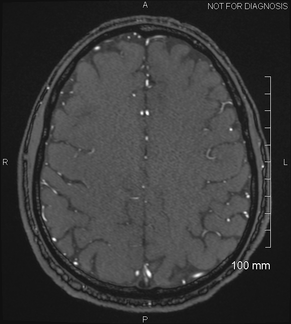 Anterior cerebral artery aneurysm (Radiopaedia 80683-94127 Axial MRA 182).jpg