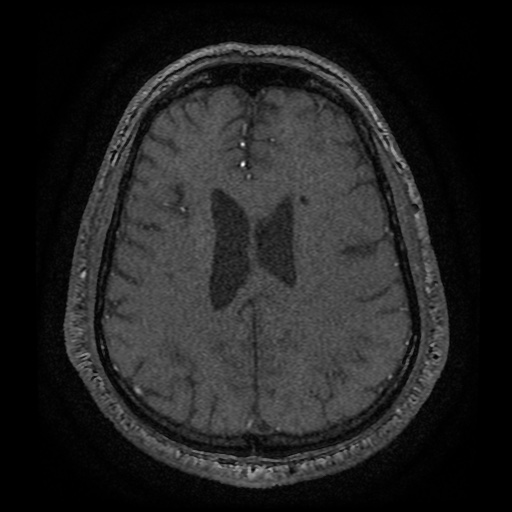 Anterior cerebral artery infarction (Radiopaedia 46794-51323 Axial MRA 155).jpg