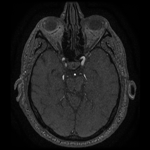 Anterior cerebral artery infarction (Radiopaedia 46794-51323 Axial MRA 66).jpg