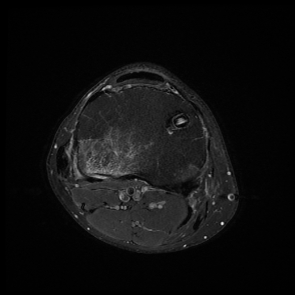 File:Anterior cruciate ligament graft tear and bucket-handle tear of medial meniscus (Radiopaedia 75867-87254 Axial PD fat sat 6).jpg