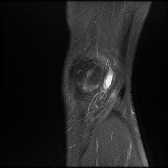 File:Anterior cruciate ligament graft tear and bucket-handle tear of medial meniscus (Radiopaedia 75867-87254 Sagittal PD fat sat 3).jpg