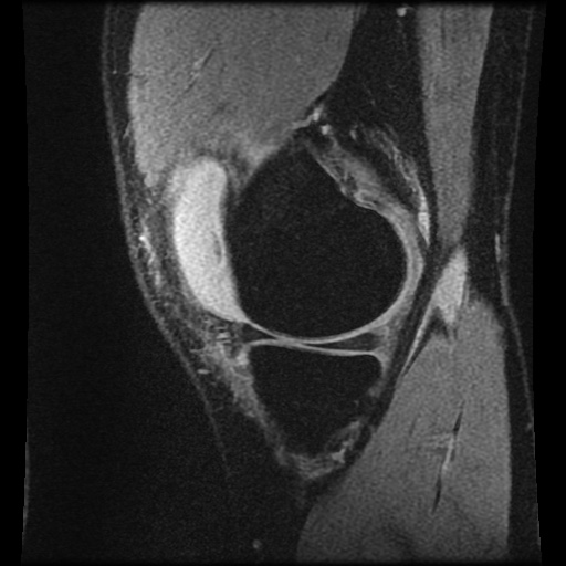 Anterior cruciate ligament tear (Radiopaedia 61500-69462 F 16).jpg