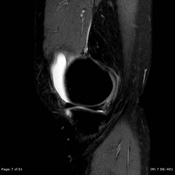 File:Anterior cruciate ligament tear (Radiopaedia 70783-80964 Sagittal STIR 7).jpg