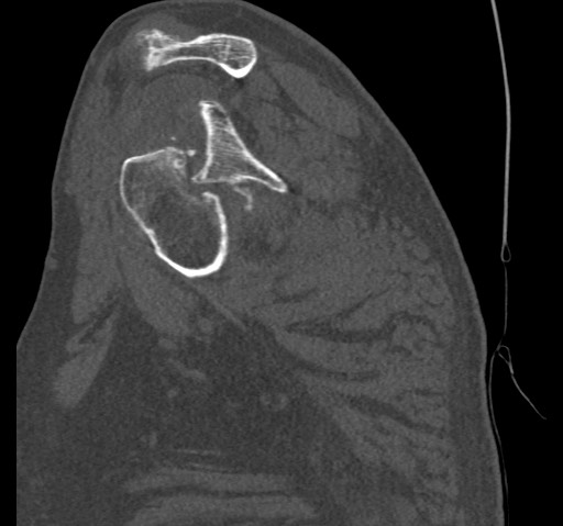 Anterior glenohumeral dislocation with Hill-Sachs lesion (Radiopaedia 62877-71249 Sagittal bone window 29).jpg