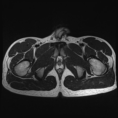 File:Anterior inferior iliac spine avulsion fracture (Radiopaedia 81312-95000 Axial T2 7).jpg