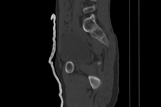 Anterior inferior iliac spine avulsion injury (Radiopaedia 88666-105376 Sagittal bone window 39).jpg