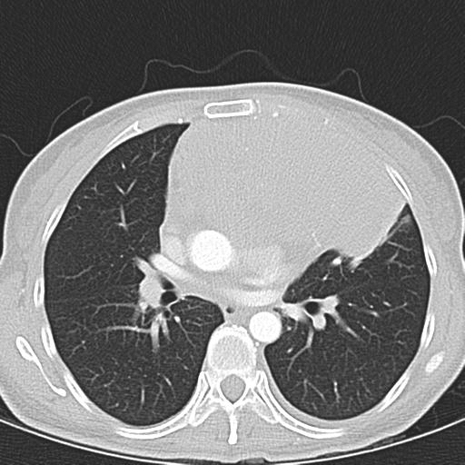 Anterior mediastinal lymphoma (Radiopaedia 29556-30061 Axial lung window 28).jpg