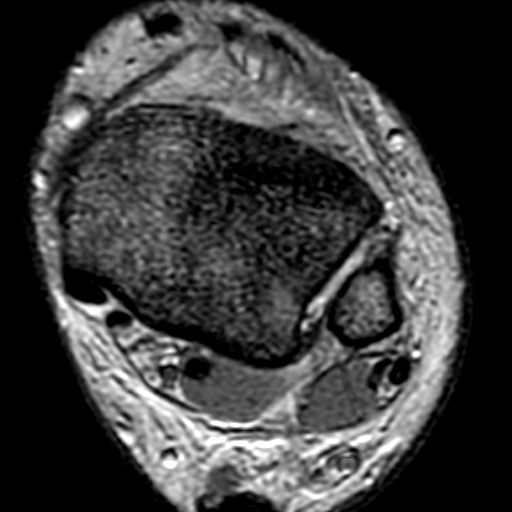 File:Anterior talofibular ligament rupture (Radiopaedia 15831-15484 Axial T2* 4).jpg