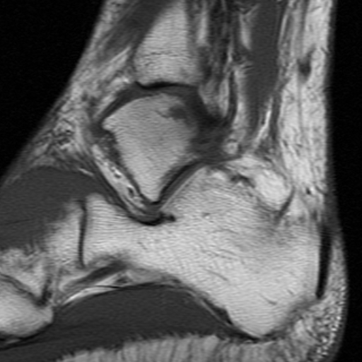 File:Anterior talofibular ligament rupture (Radiopaedia 15831-15484 Sagittal T1 6).jpg