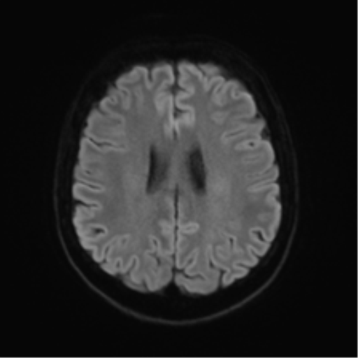 File:Anterior temporal lobe perivascular space (Radiopaedia 40946-43650 Axial DWI 45).png