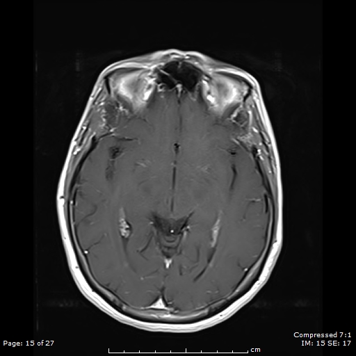File:Anterior temporal lobe perivascular space (Radiopaedia 88283-104914 Axial T1 C+ 15).jpg