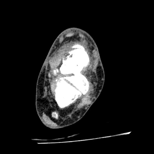 Anterior tibial artery false aneurysm (Radiopaedia 88984-105809 A 152).jpg