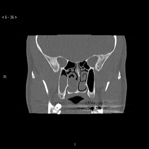 File:Antrochoanal Polyp (Radiopaedia 70510-80631 Coronal bone window 25).jpg