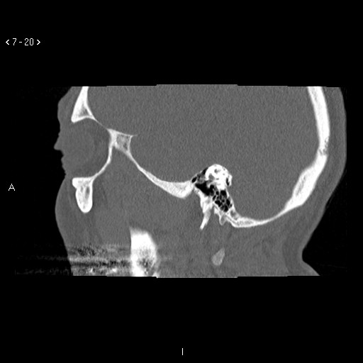 File:Antrochoanal Polyp (Radiopaedia 70510-80631 Sagittal bone window 10).jpg