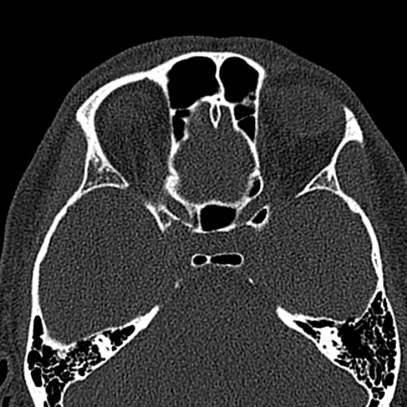 Antrochoanal polyp (Radiopaedia 30002-30554 Axial bone window 44).jpg